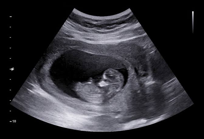 Baby ultrasound scan — the IVF outcome that started IVFComputer